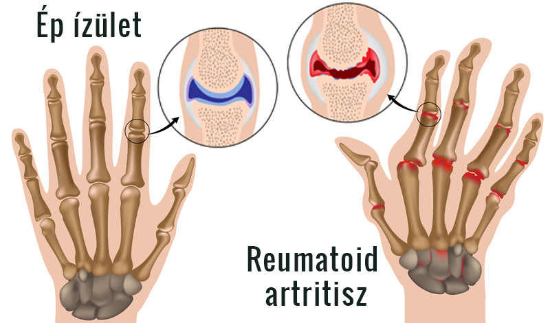 rheumatoid arthritis kéz tünetei