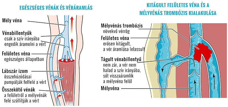 ízületi vérrög lábkezelés májbetegségek ízületek