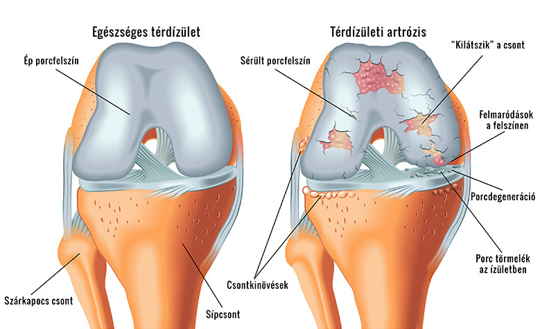 fizioterápia a térd artrózisának kezelésére