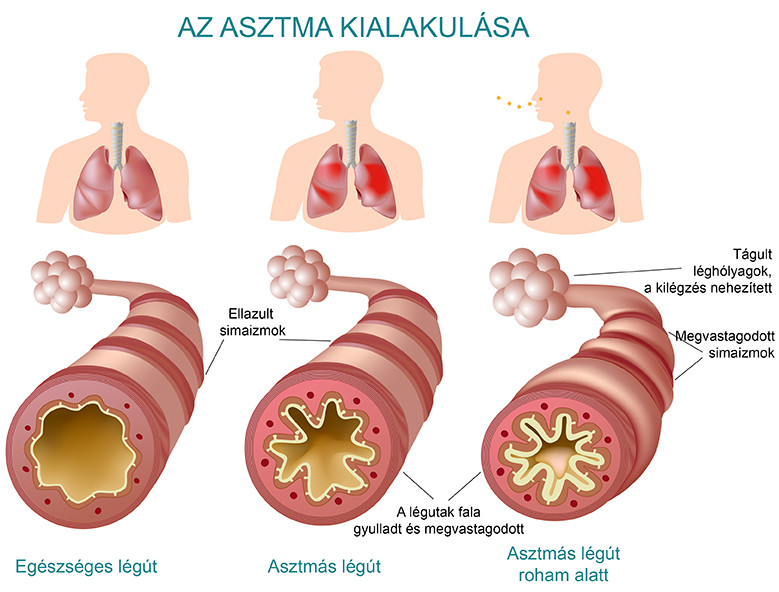 Az asztma kialakulása és a légutak elváltozásai