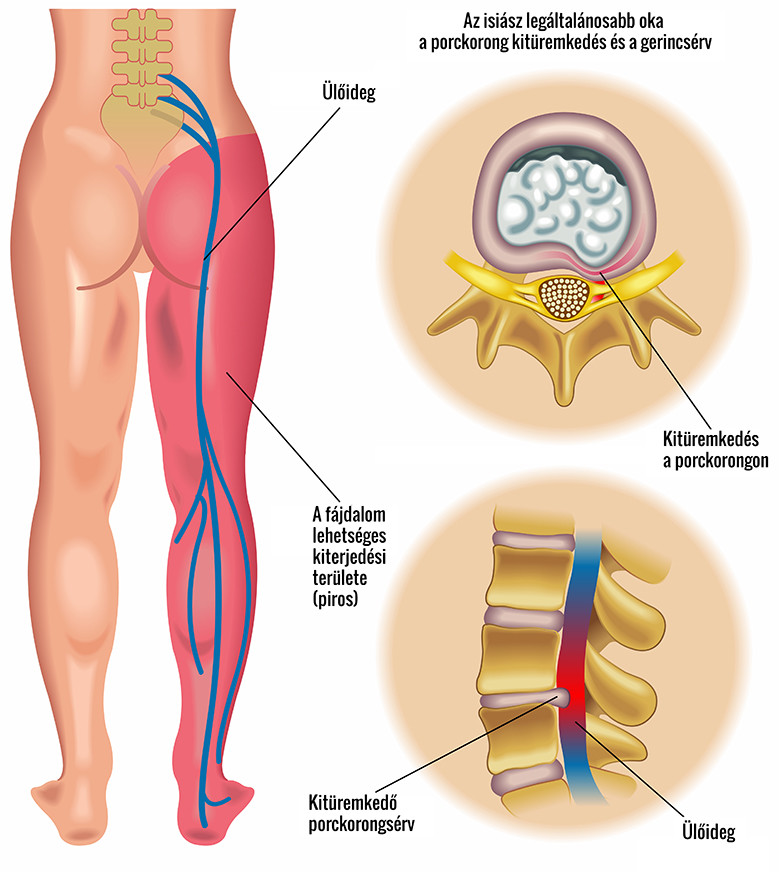 Izom-csontrendszeri betegségek kezelése – Calendula Clinic