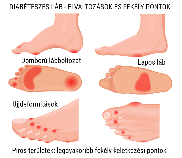 cukorbetegség szövődményei láb kezelése