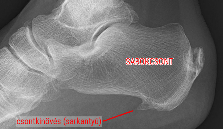 csontok és calcaneus artrosis kezelése)