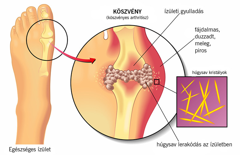 a láb kisujja ízületei fájnak amikor a csípőízület fáj a tünetekről