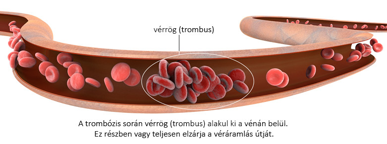 Mélyvénás trombózis tünetei és kezelése - HáziPatika, Trombus képződés és visszér
