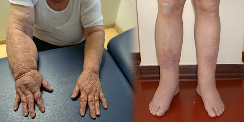 Ne féljünk az artrózistól | TermészetGyógyász Magazin
