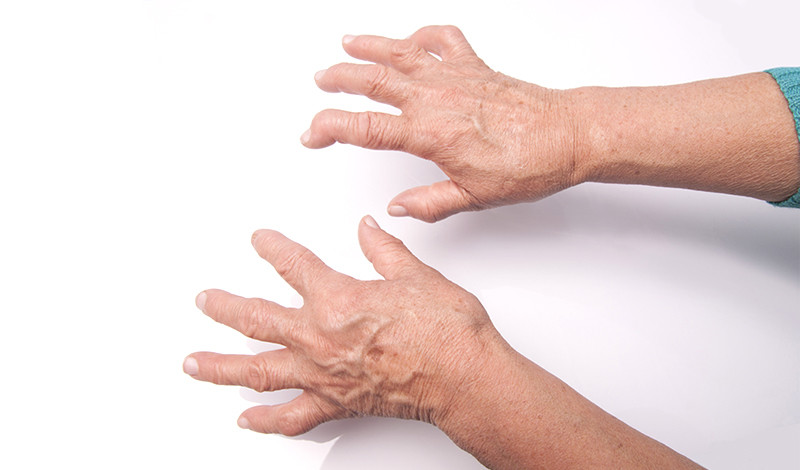 hogyan lehet kezelni az akut artritisz