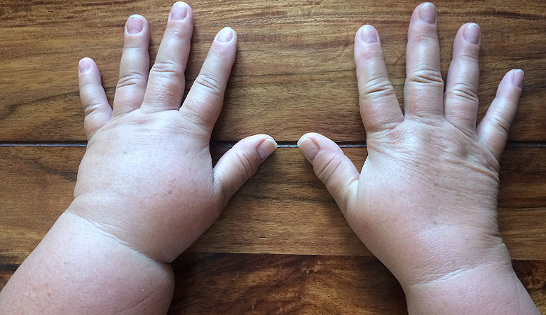 a kéz végtagjai artrózisa kezelés