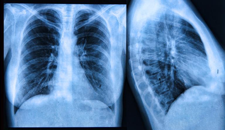 A tüdőrák tünetei - mik a legáltalánosabb panaszok? | radar-tronic.hu