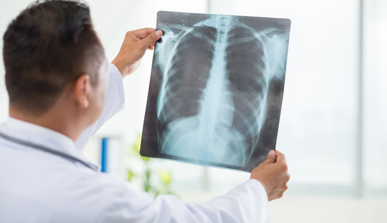 COPD: a tüdő fele is elveszhet, mire észreveszik - EgészségKalauz