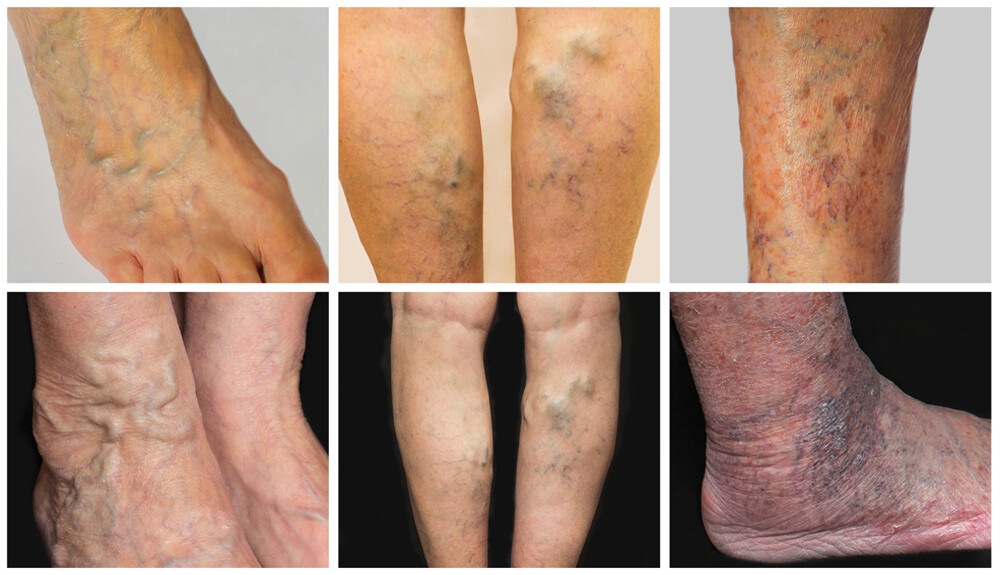 a varikózis szövődményei a lábakon