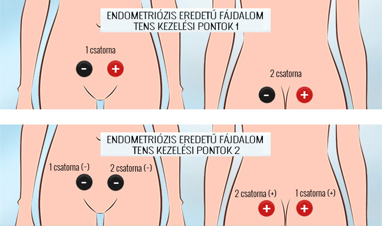fájdalom a csípőízületekben endometriosissal meszesedés lelki okai