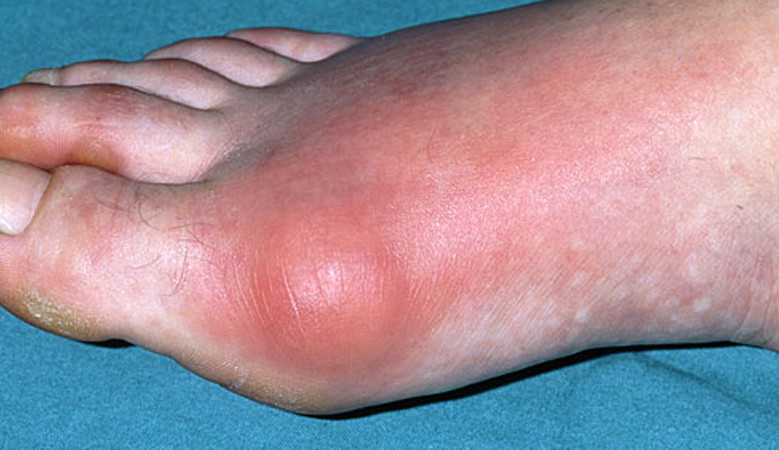 A nagy lábujj ízületi tünetei és kezelése
