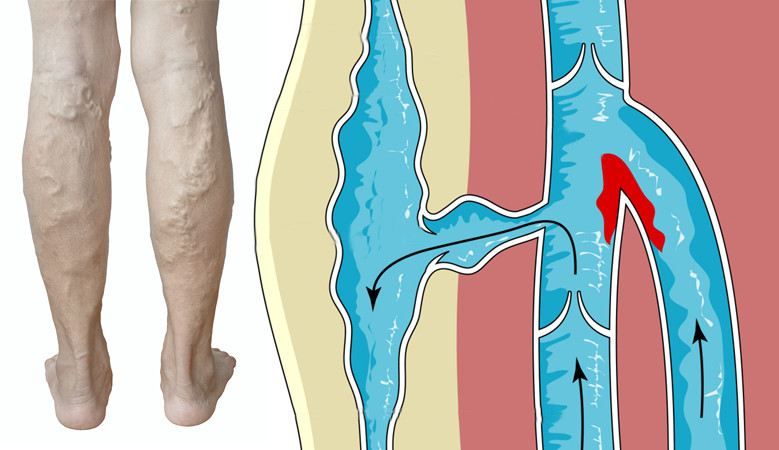Műtét visszér sok fájdalom a láb - Hogyan kell kezelni a visszér hidzsámával