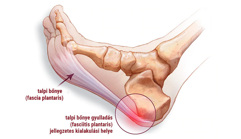 a láb interfalangeális ízületének gyulladása fagyos kézízületek kezelése