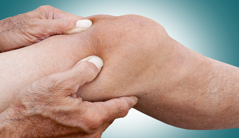 Gerinc artritisz - leírás és javasolt gyógykezelés