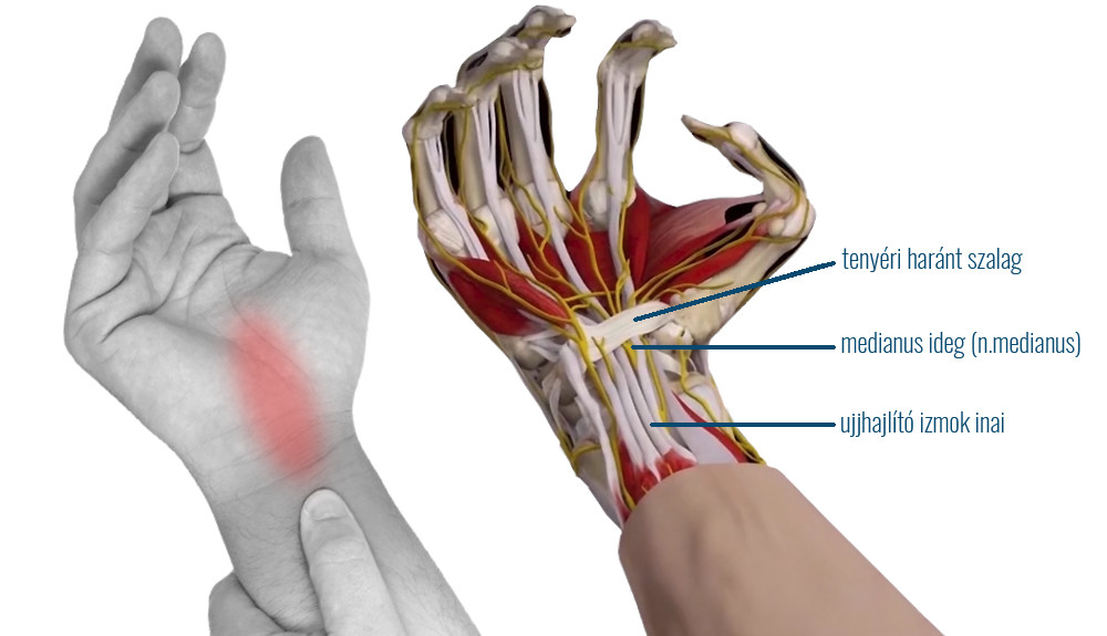 csukló fájdalom egy régi sérülés után a térd artrózisa súlyosbodásának tünetei