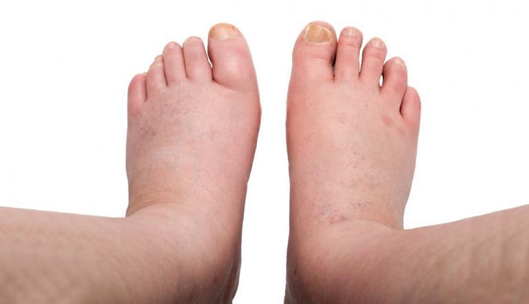 Visszeres láb - Visszérbetegség