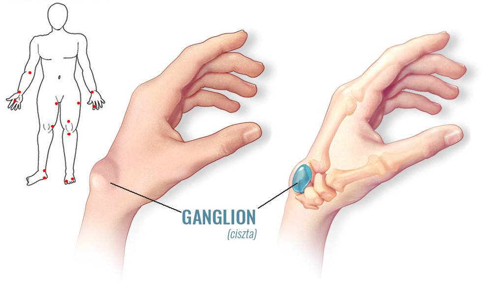 Ganglion eltávolítás, Csukló-ín ganglion kezelés