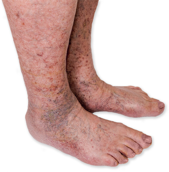 Alsó lábszár foltosság - Visszérbetegség - Barna foltok az alsó lábszáron visszérrel