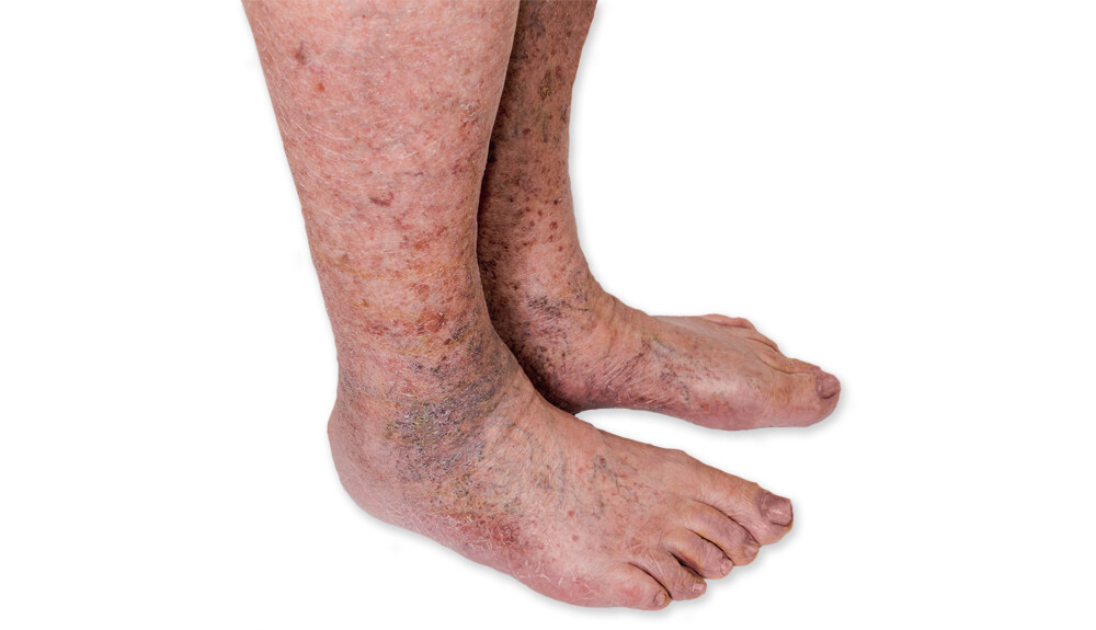 piros foltok jelentek meg a lábakon és a fotó fáj