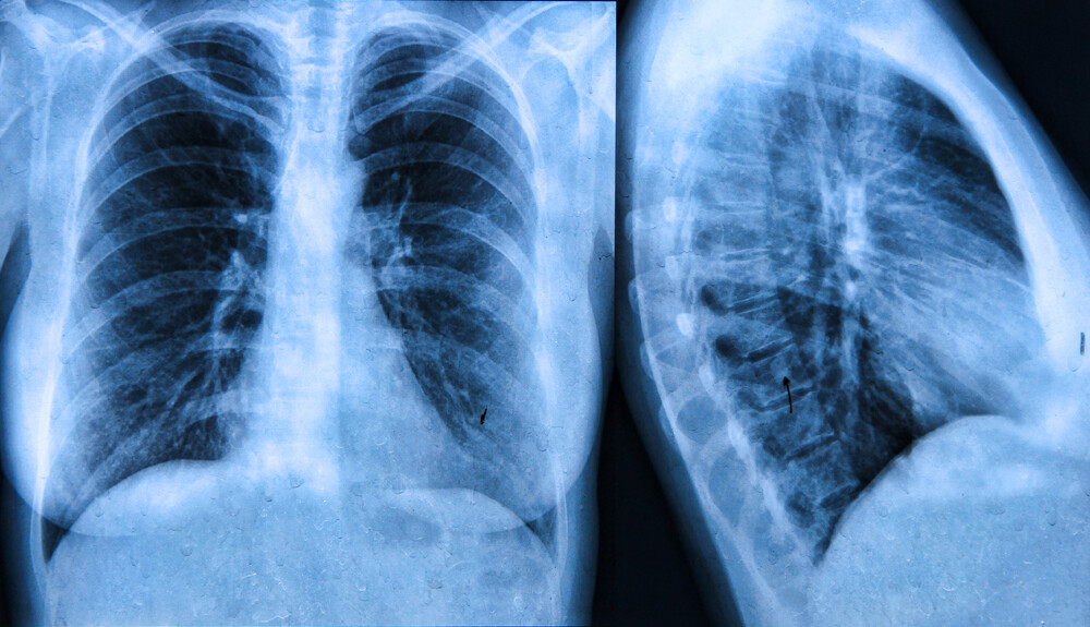 fogyás mellkas röntgen